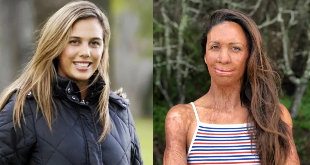 turia pitt story