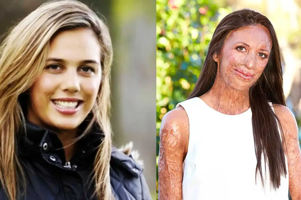 Turia Pitt